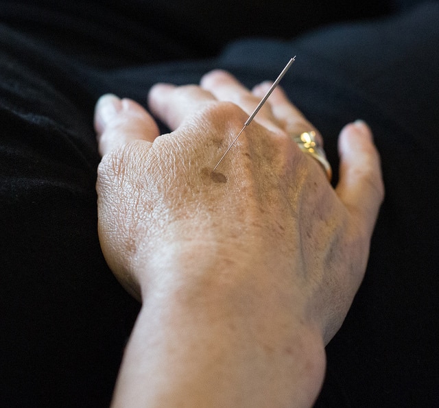 Acupuncture Needle