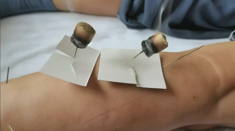 Warm-needle acupuncture improve the degenerative knee osteoarthritis ...